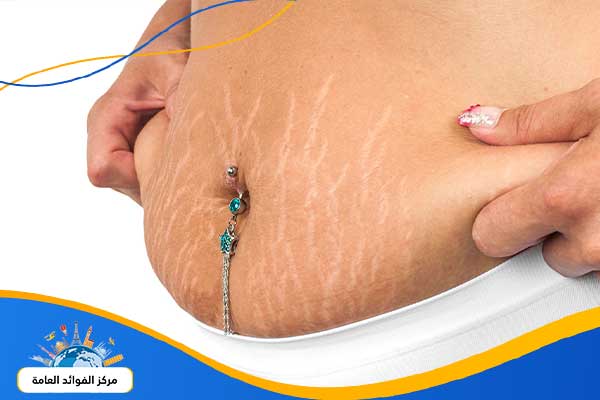 ما هي علامات تمدد الجلد بعد الولادة ؟