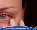 هل حساسية العين تسبب صداع